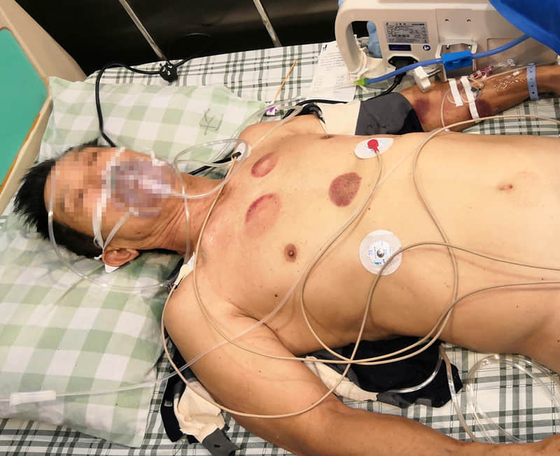 抢救记录： 生命相托，分秒必争——记1例恶性心率失常反复室颤心跳呼吸骤停患者抢救成功