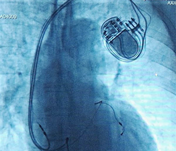 七旬老人患心率失常、冠心病险象环生，永久心脏起搏器解除“心头大患”！