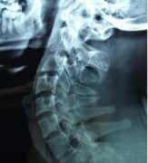 股骨头坏死都有哪些症状?