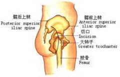 患有股骨头坏死会有哪些症状？
