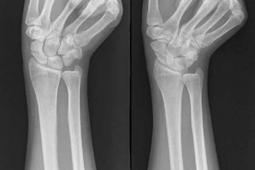 骨折患者补钙好不好？