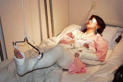 骨折患者饮食需要注意哪方面？