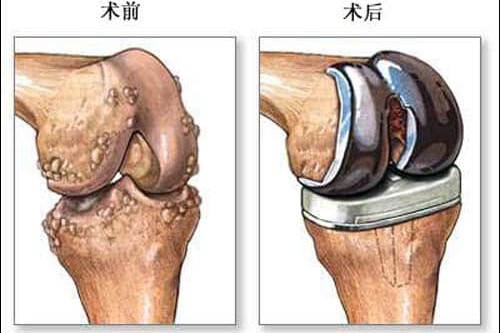 骨折手术治疗最佳时机是什么时候？