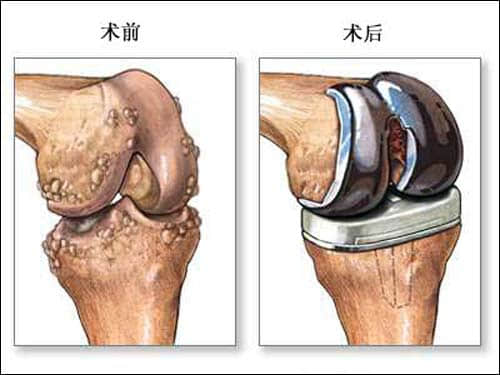 骨折手术治疗最佳时机是什么时候? 骨折手术治疗最佳时机是什么时候?