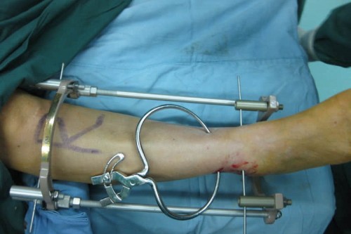 如何判断骨折是否愈合？