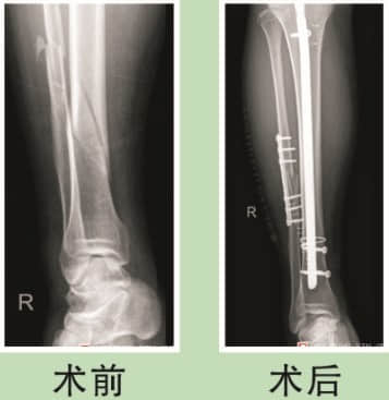 骨折案例分享 骨折案例分享