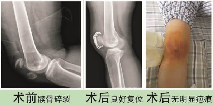 骨折案例分享 骨折案例分享
