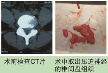 脊柱骨折案例分享 脊柱骨折案例分享
