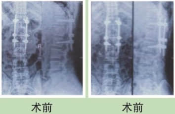 脊柱骨折案例分享 脊柱骨折案例分享