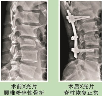 脊柱骨折案例分享 脊柱骨折案例分享