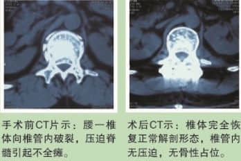 脊柱骨折案例分享 脊柱骨折案例分享