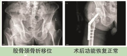 老年人骨折案例分享 老年人骨折案例分享