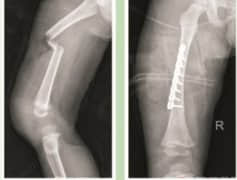 小儿骨折案例分享