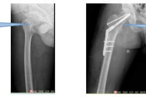 “看骨科就到广药三院”真实案例展示一
