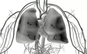 关于肺气肿的相关常识