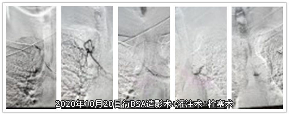 2020年10月20日行DSA造影术+灌注术+栓塞术.png