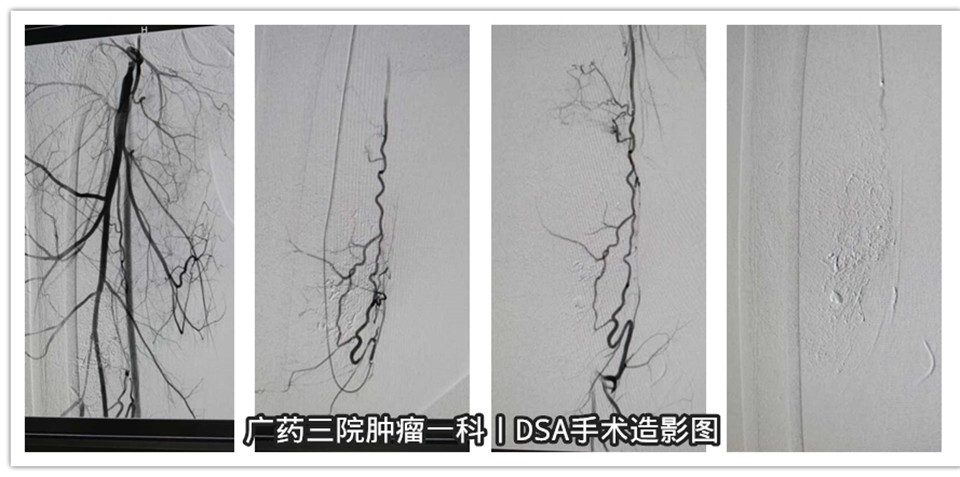 刘嘉文，男，19岁，右下肢肿物栓塞术。 (4)_副本.jpg