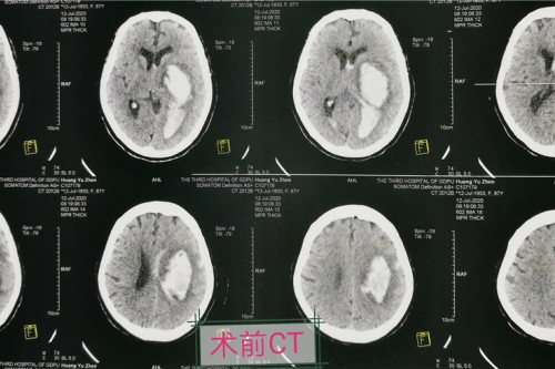 探索生命禁区，我院神经外科成