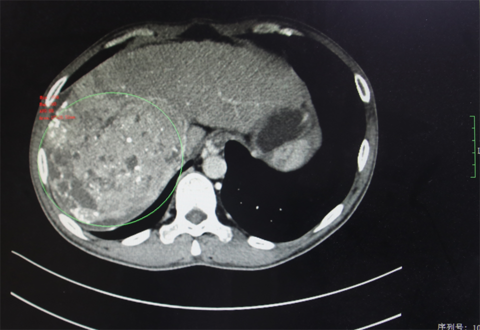 肝癌晚期ct图片图片