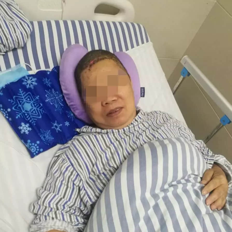 惊险!阿婆脑动脉瘤破裂命悬一线,医生精准“排雷”救回生命。 惊险!阿婆脑动脉瘤破裂命悬一线,医生精准“排雷”救回生命。