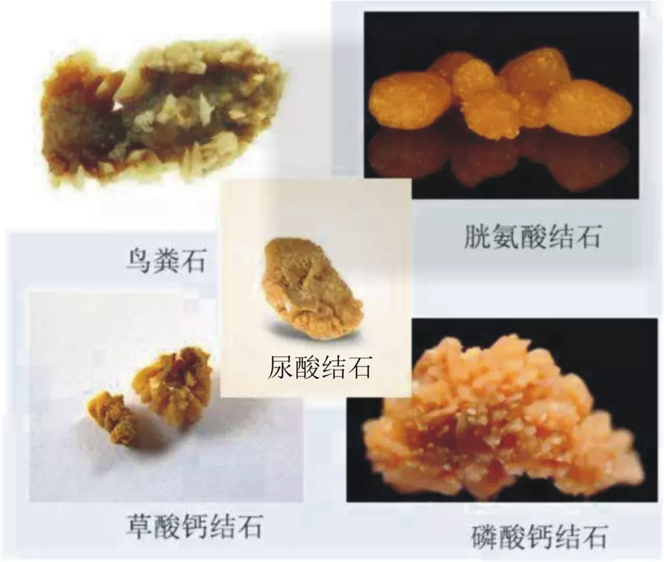 多喝苏打水可防尿酸结石?医生提醒:有效但需适量